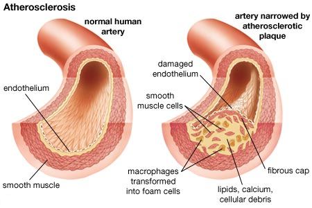 Arteriosclerotic-Cardiovascular-Disease.jpg