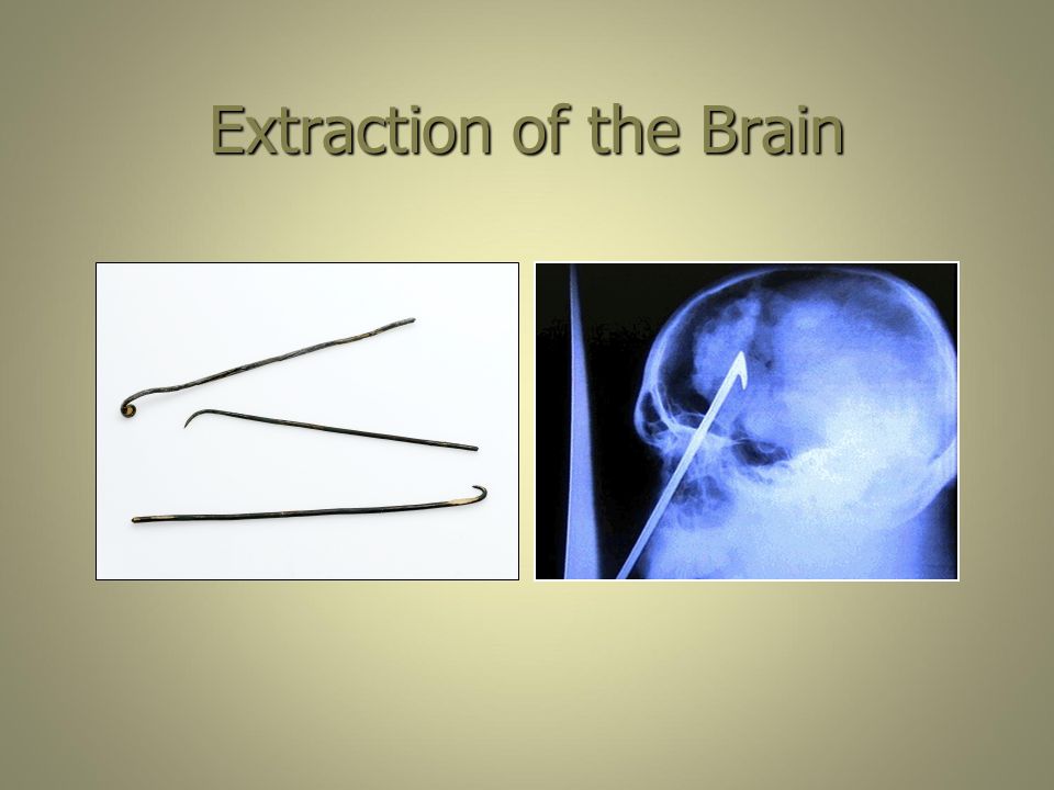 Extraction+of+the+Brain.jpg
