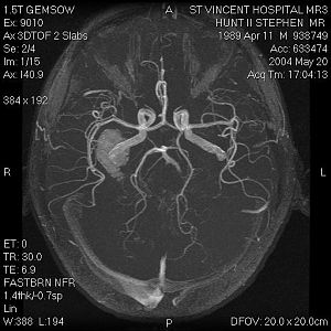 The large mass towards the left is the AVM (arteriovenous malformation) that prompted my brain surgery on 5/24/04.    An AVM is a bundle of arteries and veins that begin to bleed out into the brain...