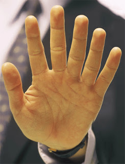 Central+Polydactyly+-+clinical+image.jpg