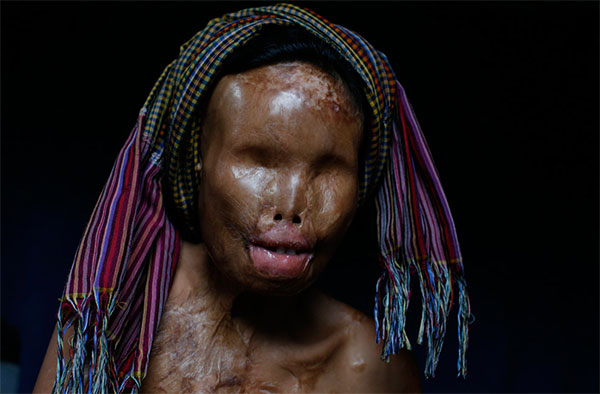 acid-attack-victim2.jpg