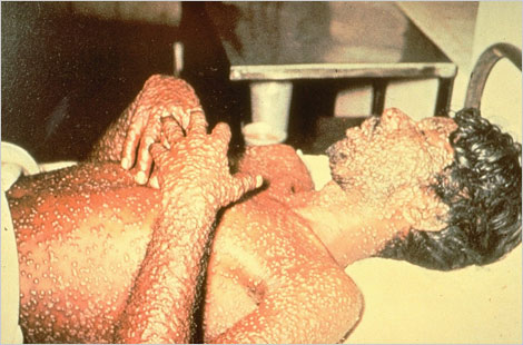 smallpox-1-lg.jpg