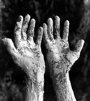 leprosy_hands-1.jpg
