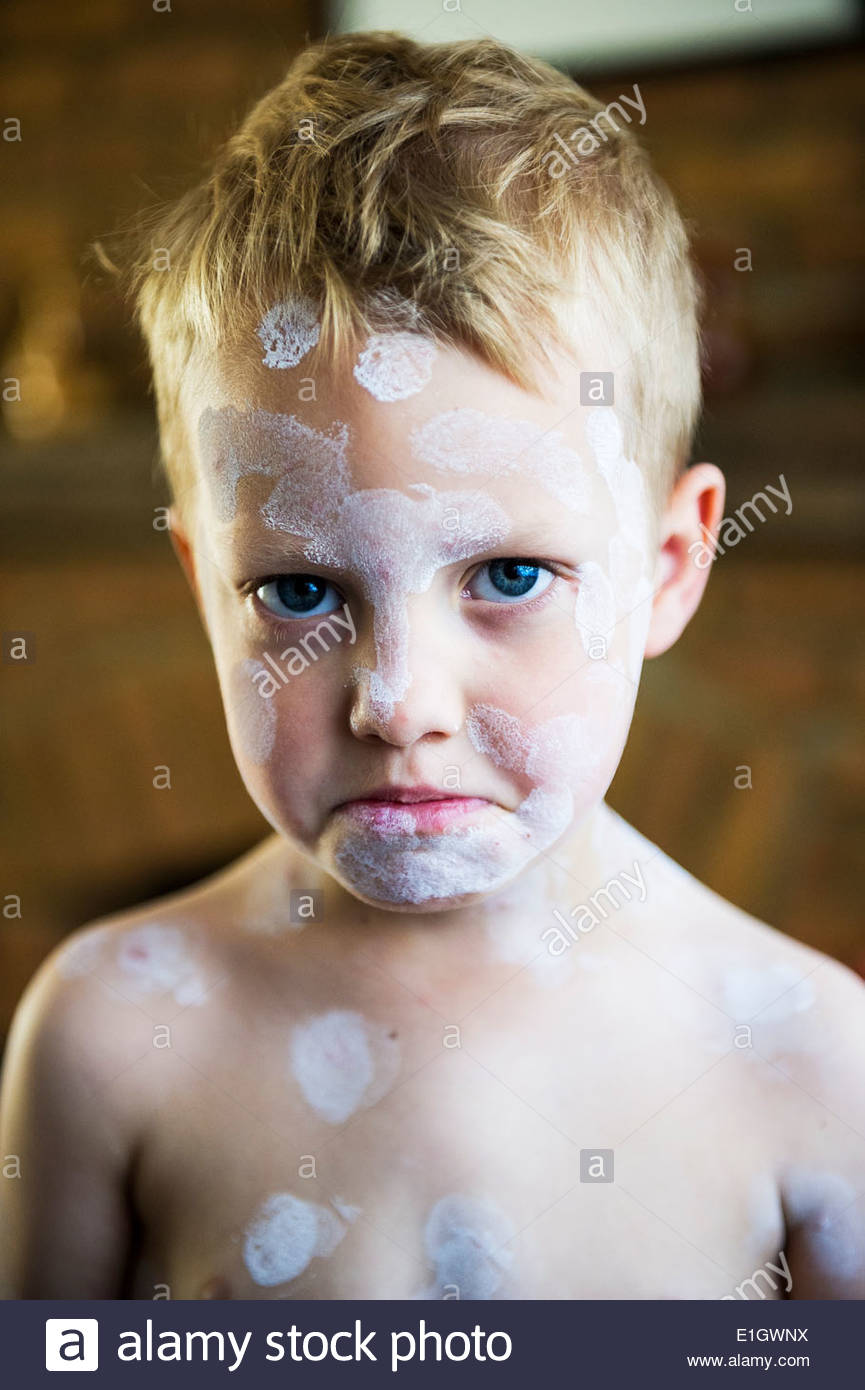 a-five-year-old-boy-being-treated-with-calamine-lotion-for-chicken-E1GWNX.jpg