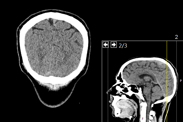 CT_of_a_normal_brain%2C_coronal_50.png