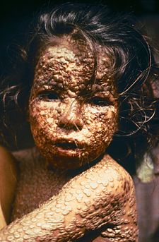 225px-Child_with_Smallpox_Bangladesh.jpg