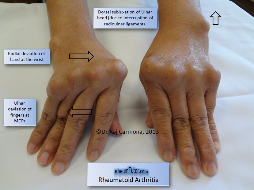 Rheumatoid-Arthritis-1e.jpg